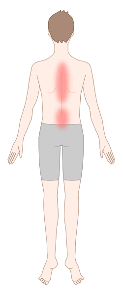 転移性脊椎腫瘍で生じる痛みの部位