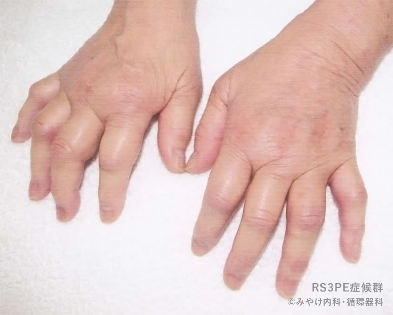 RS3PE症候群：自験例の手指の浮腫