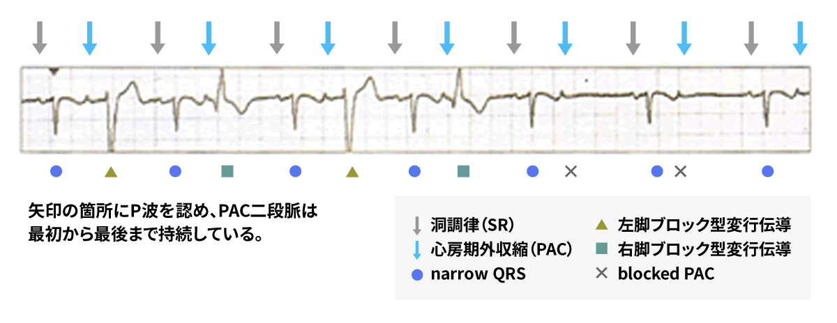上室性不整脈の心電図