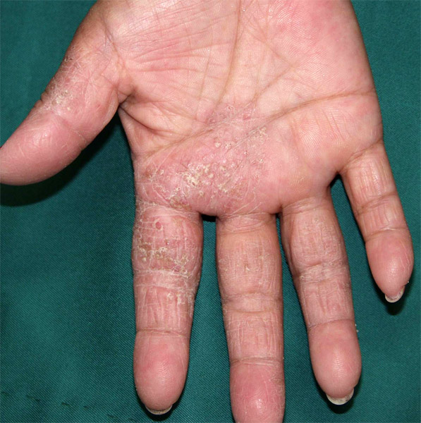 【写真1】掌蹠膿疱症（しょうせきのうほうしょう）の手の水泡