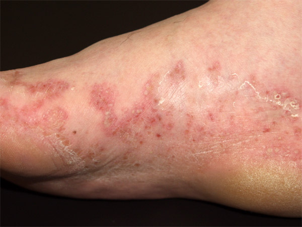 【写真2】掌蹠膿疱症（しょうせきのうほうしょう）の足の裏の水泡
