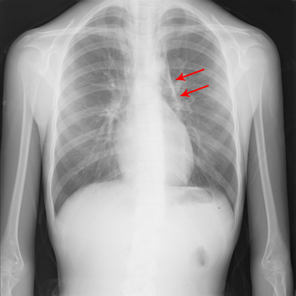 縦隔気腫の胸部レントゲン写真