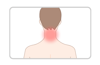石灰沈着性頸長筋腱炎で生じる痛みの部位