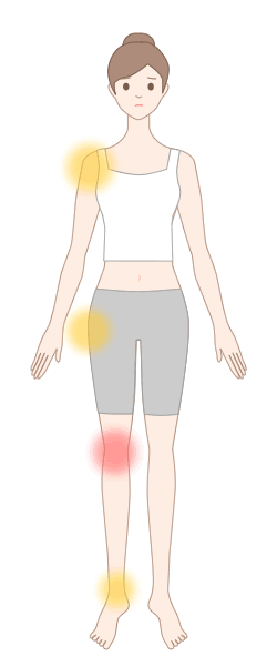 化膿性関節炎で生じる痛みの部位（※赤丸は主な関節痛の部位）
