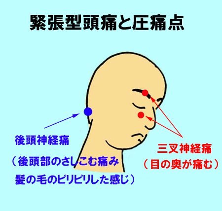【図3】緊張型頭痛と圧痛点
