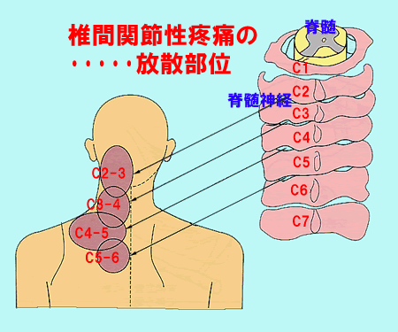 【図13】椎間関節性疼痛の放散部位