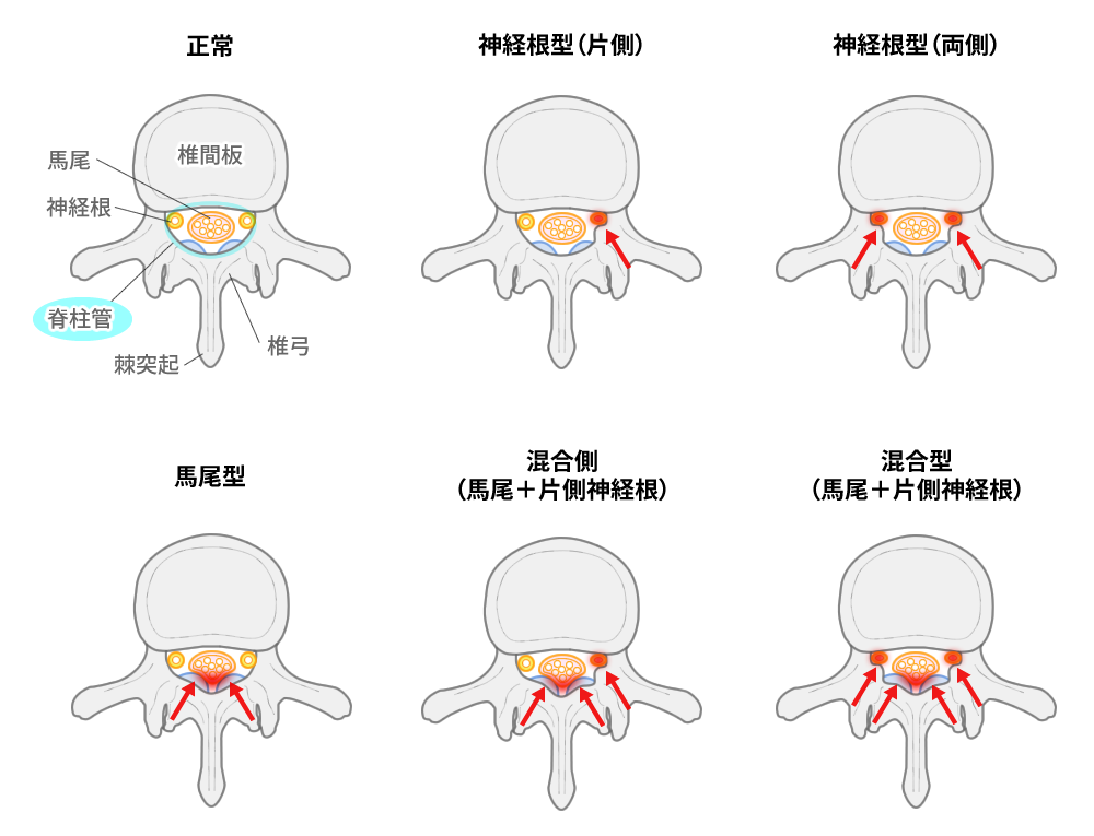 腰部脊柱管狭窄の神経障害形式（横断模式図）