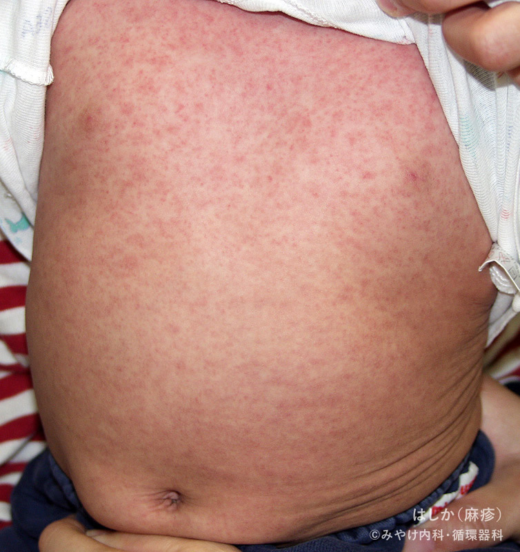 はしか（麻疹）-写真11　発病後8日～10日（回復期）