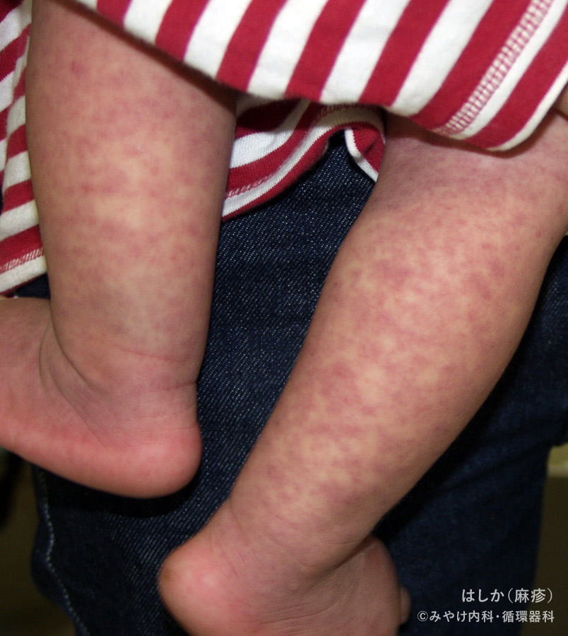 はしか（麻疹）-（写真6）発病後8日～10日（回復期）