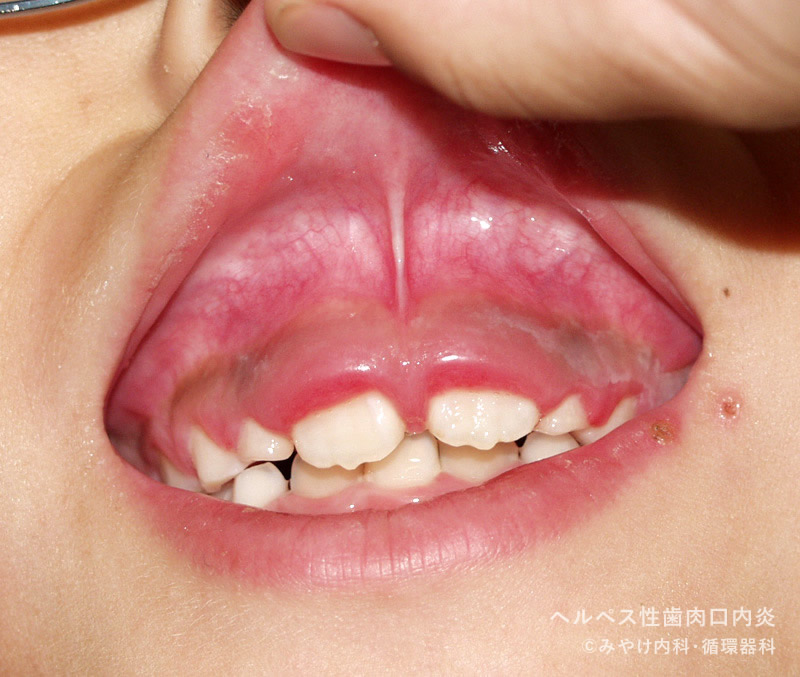写真で見るヘルペス性歯肉口内炎