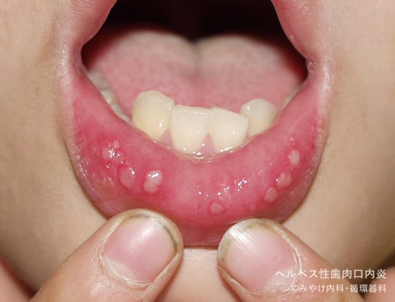 写真で見る「子どもの病気」：ヘルペス性(歯肉)口内炎