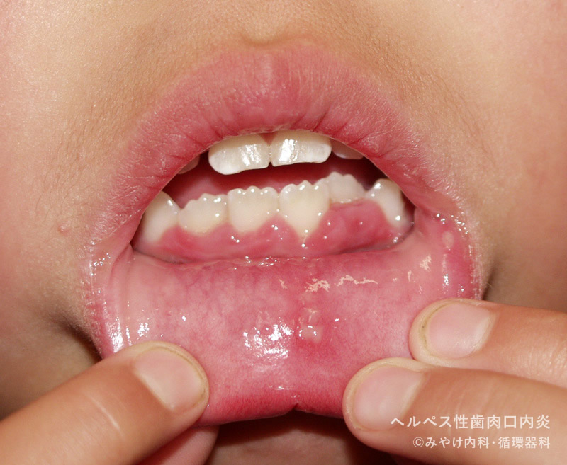ヘルペス性（歯肉）口内炎-写真09　歯肉の発赤・腫脹