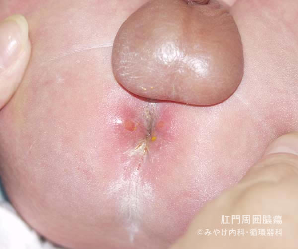肛門周囲膿瘍-写真01