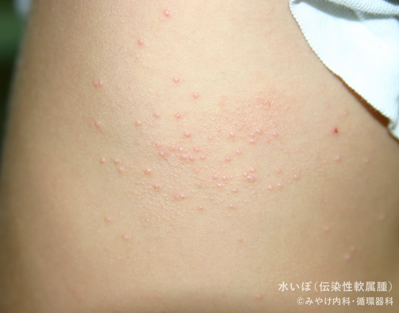 伝染性軟属腫の症状は何ですか?