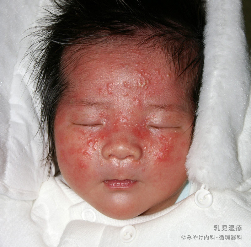 乳児湿疹と乳児脂漏性皮膚炎