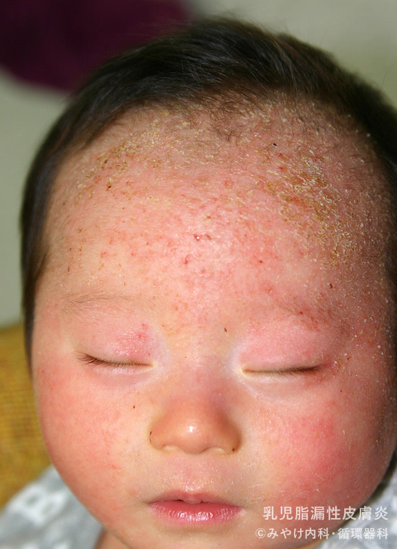 乳児湿疹と乳児脂漏性皮膚炎