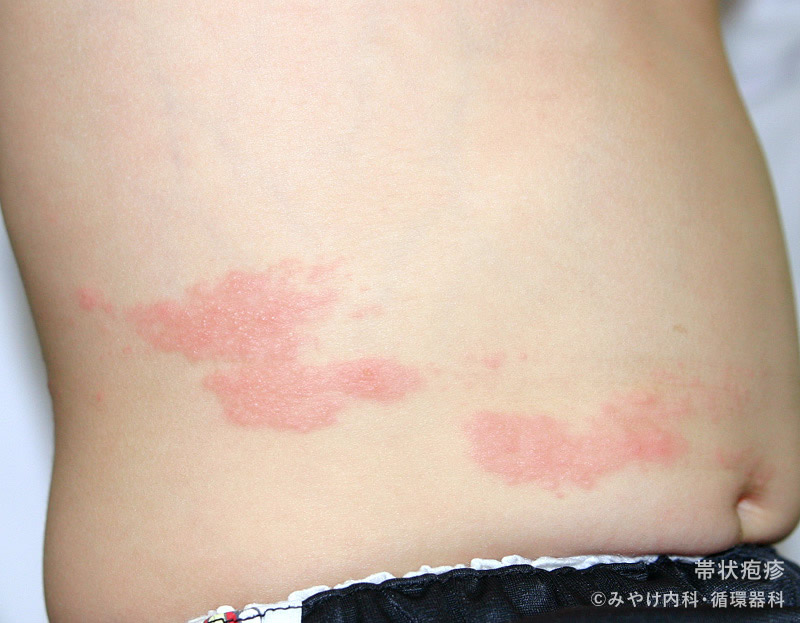 疱疹状皮膚炎の写真