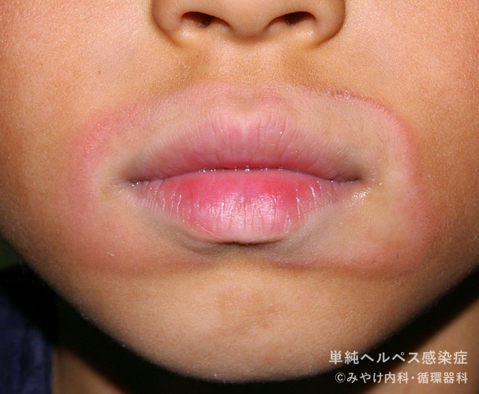単純ヘルペス感染症-写真16　口唇ヘルペス