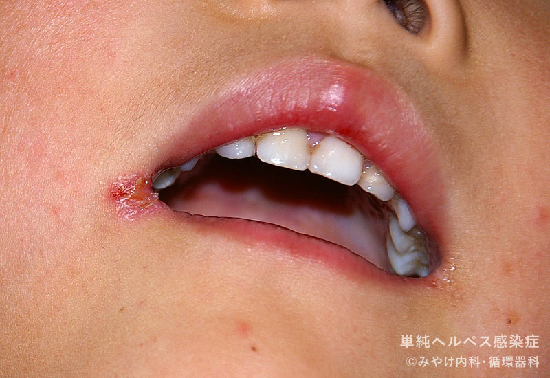 単純ヘルペス感染症-写真18　口唇ヘルペス
