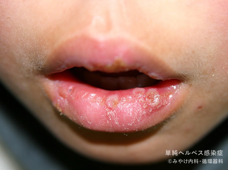 単純ヘルペス感染症-写真23　口唇ヘルペス
