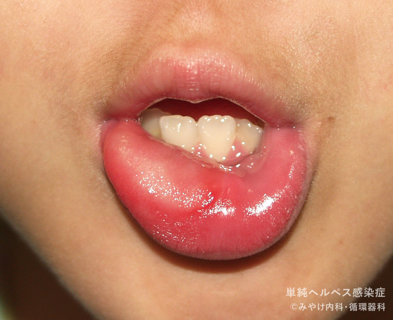 単純ヘルペス感染症-写真28　口唇ヘルペス