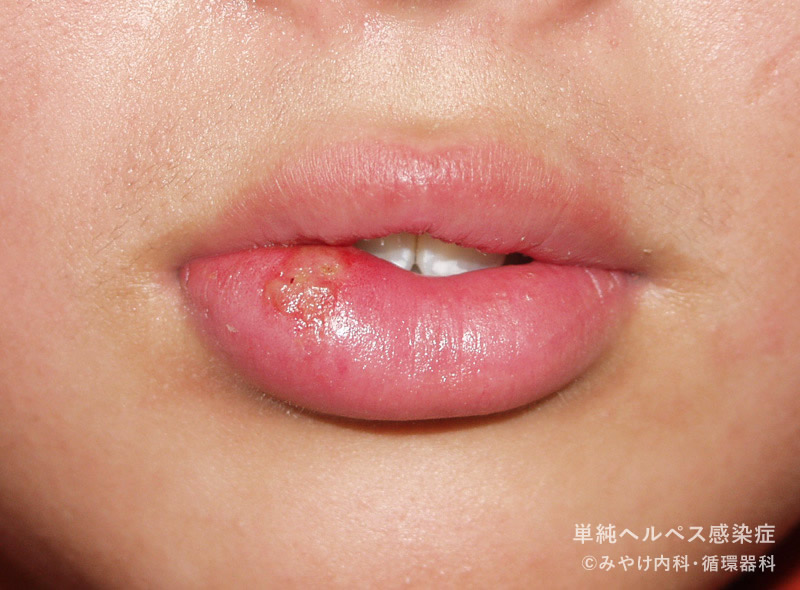 単純ヘルペス感染症-写真29　口唇ヘルペス