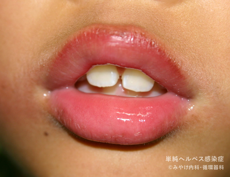 単純ヘルペス感染症-写真30　口唇ヘルペス