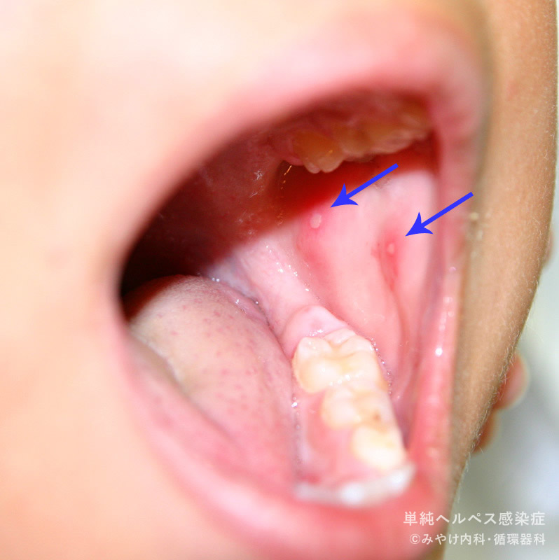 単純ヘルペス感染症-写真32　頬部、舌ヘルペス