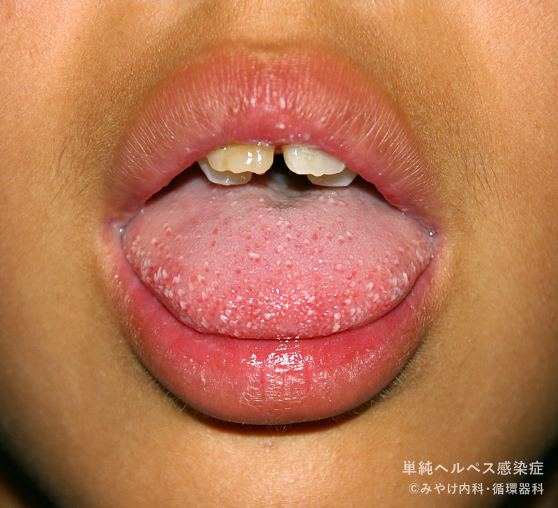 中 水疱 の 口 こんな歯茎の水ぶくれは危険！誰でもわかる歯茎の水ぶくれ・水疱・できもの診断