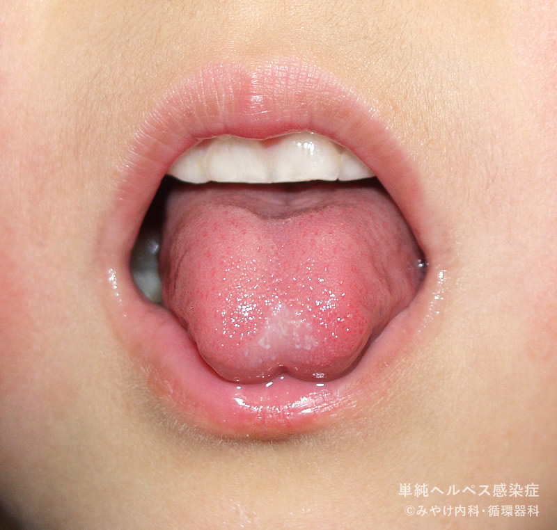 単純ヘルペス感染症-写真36　頬部、舌ヘルペス