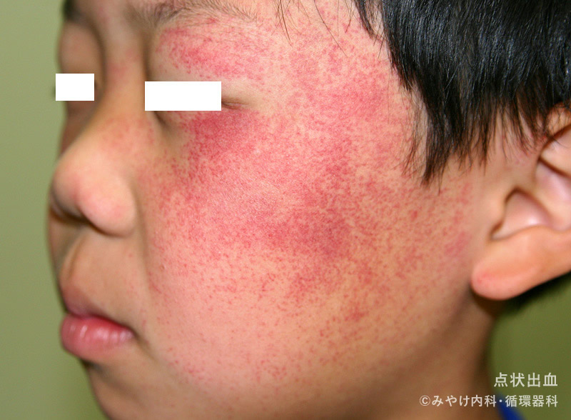 パップスミア後の出血や斑点の原因