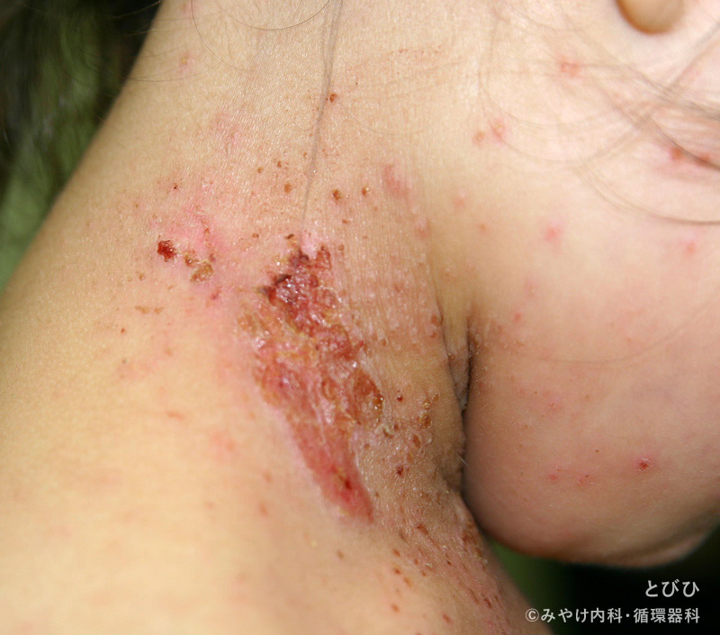 ブドウ球菌性熱傷様皮膚症候群（SSSS） ｜ よく見られる子どもの病気 