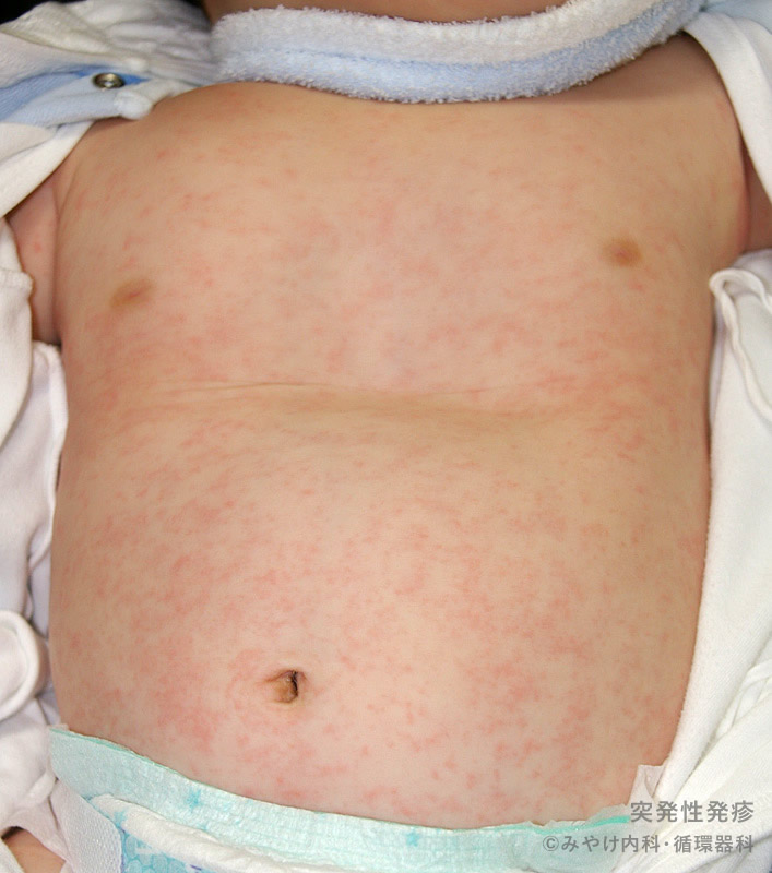 突発性発疹－写真１　からだのおへそを中心に大きさの異なる赤い斑点が出てきます。