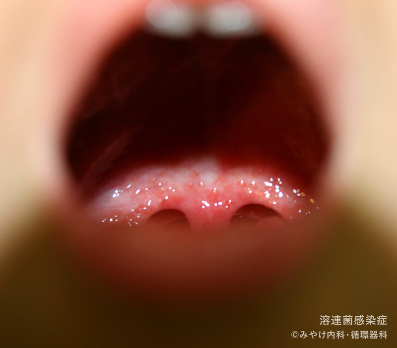 溶連菌感染症の口の中の変化