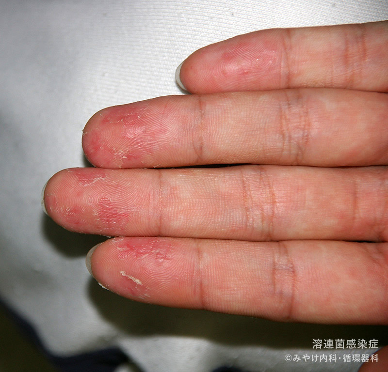 溶連菌感染症の手足の皮膚の変化