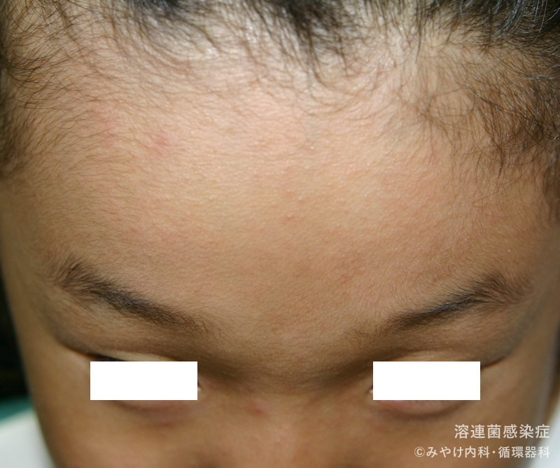 （写真2）溶連菌感染症の顔の皮膚変化