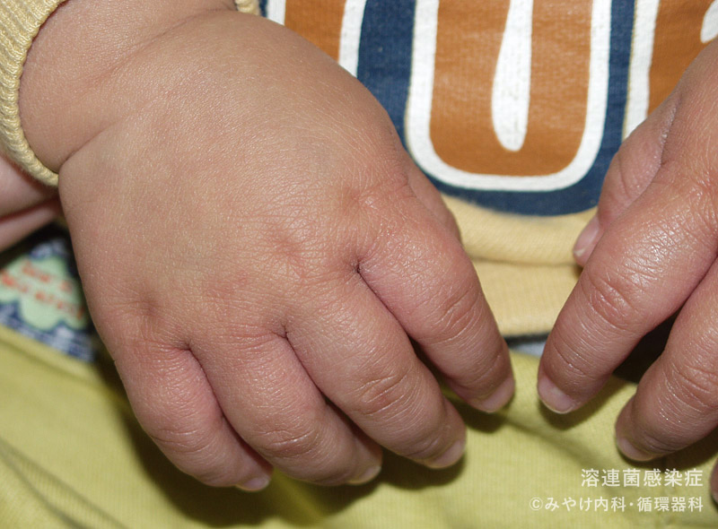 （写真11）溶連菌感染症の手の皮膚変化