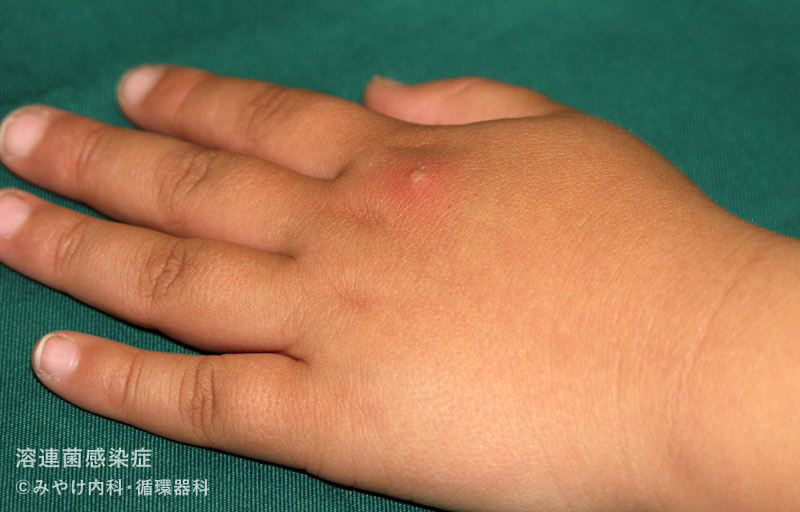 （写真12）溶連菌感染症の手の皮膚変化