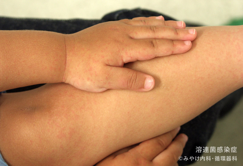 （写真15）溶連菌感染症の手足の皮膚変化