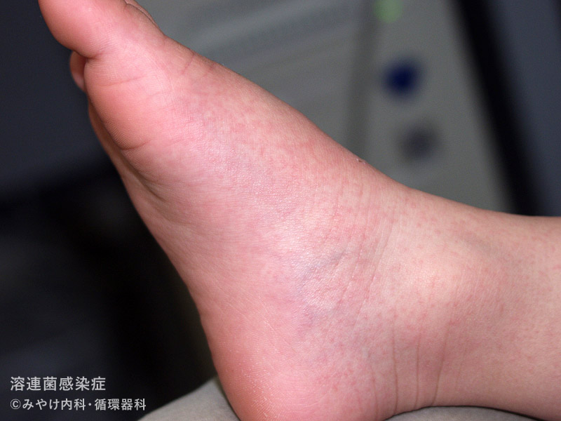 （写真18）溶連菌感染症の足の皮膚変化