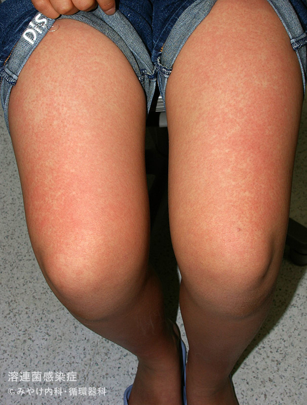 （写真19）溶連菌感染症の足の皮膚変化