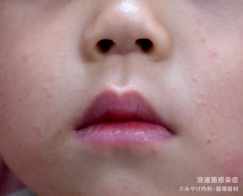 （写真3）溶連菌感染症の顔の皮膚変化