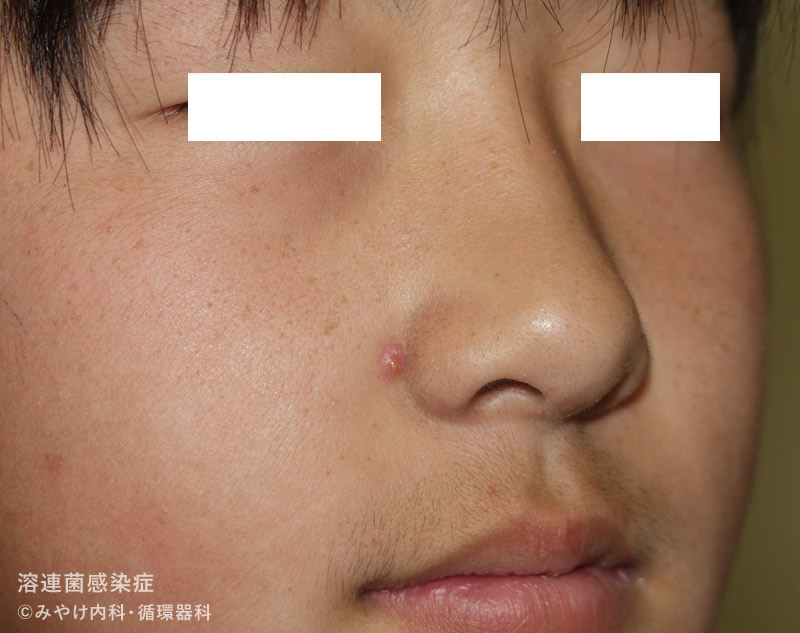 （写真4）溶連菌感染症の顔の皮膚変化