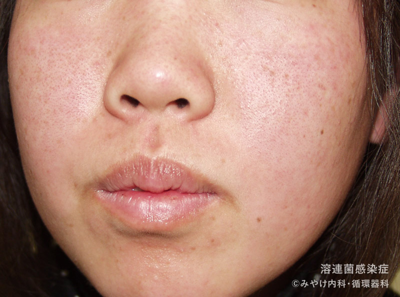 （写真6）溶連菌感染症の顔の皮膚変化