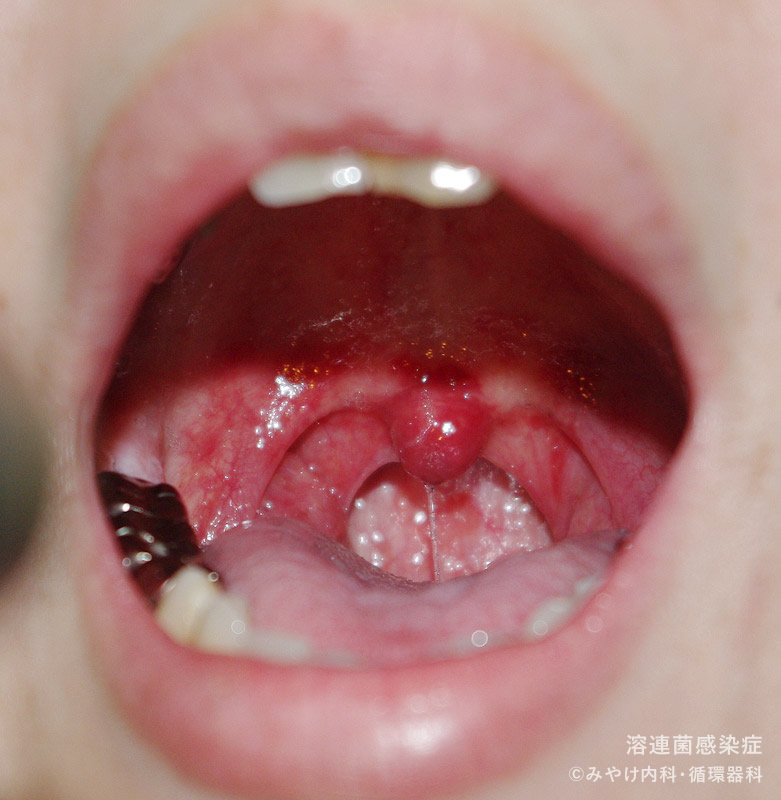 （写真1）溶連菌感染症の口の中の変化