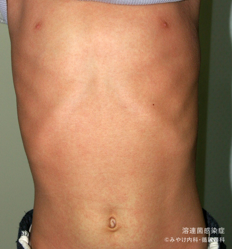 （写真8）溶連菌感染症のからだの皮膚変化