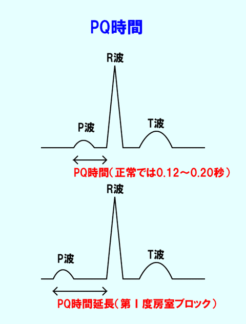 P波からQ波までの時間（PQ時間といいます）は、スイッチが入ってから電気が心室に入るまでの時間を表しています。