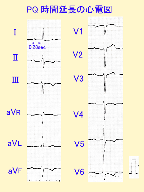 PQ時間延長の心電図　PQ時間が延長しているときは、心房から心室までの電気の通りが悪くなり、時間が長くかかることが分かります