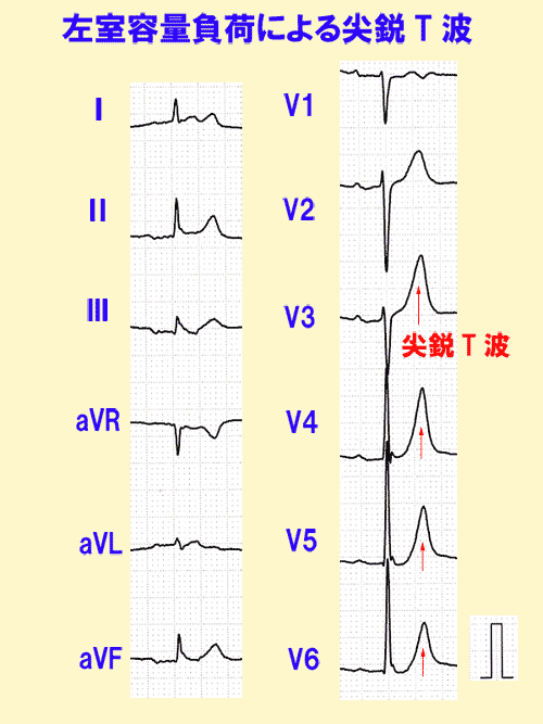 左室容量負荷による尖鋭T波の心電図