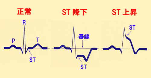 正常時とST降下、ST上昇の心電図変化